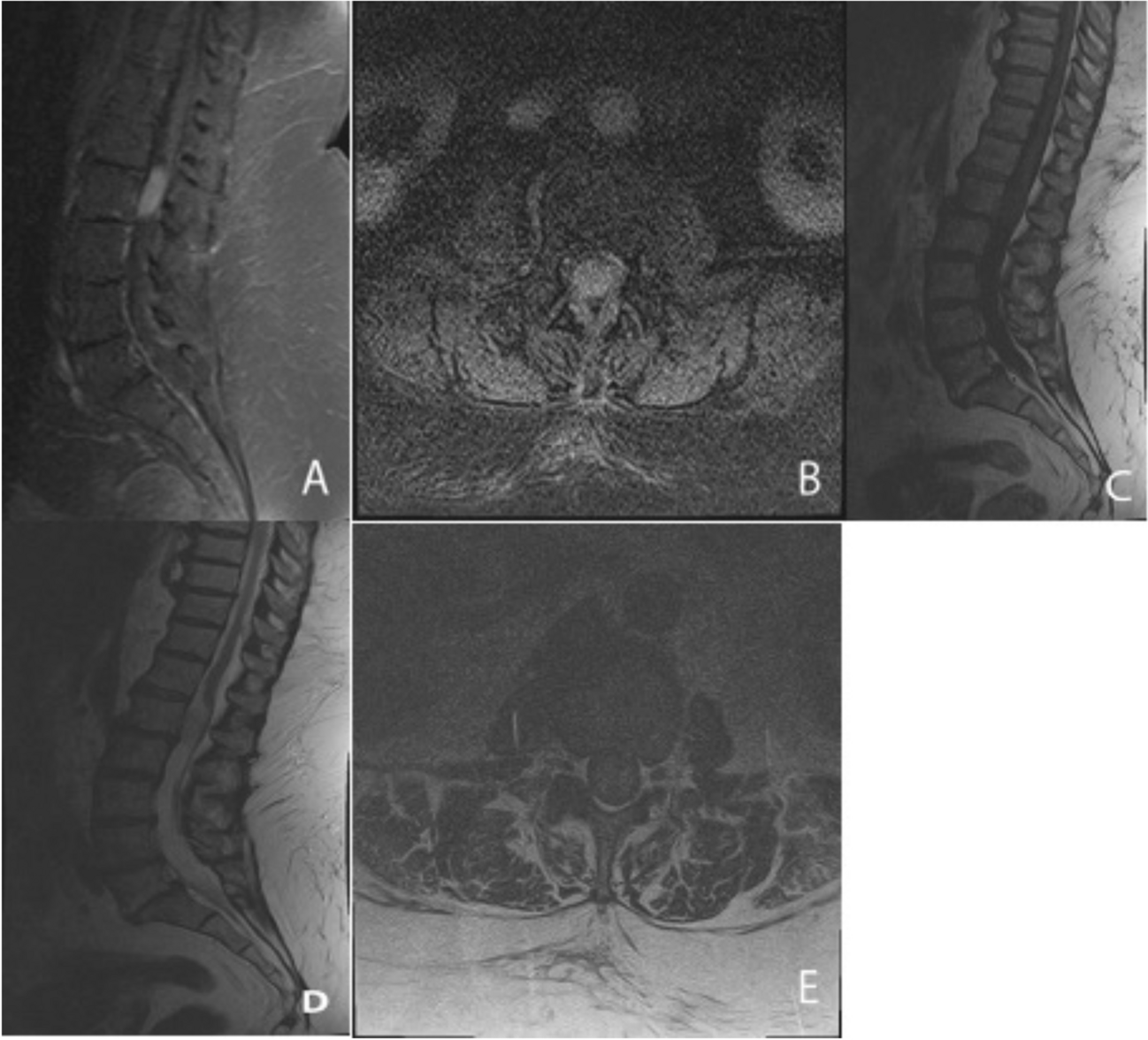 Cauda equina neuroendocrine tumor: a report of three cases and review of the literature with focus on differential diagnosis and postoperative management