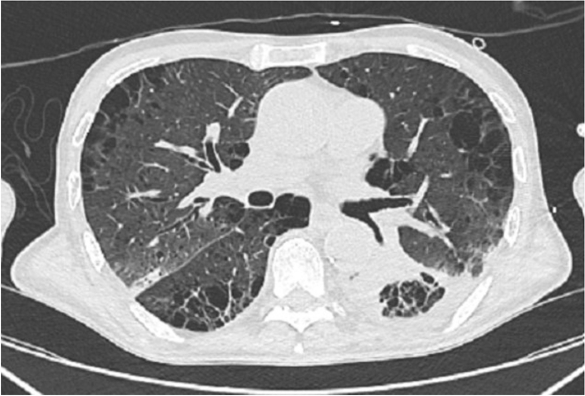 Noninvasive respiratory support with high-flow nasal cannula in endoscopic surgery in a patient with Legionella Pneumophila pneumonia: a case report