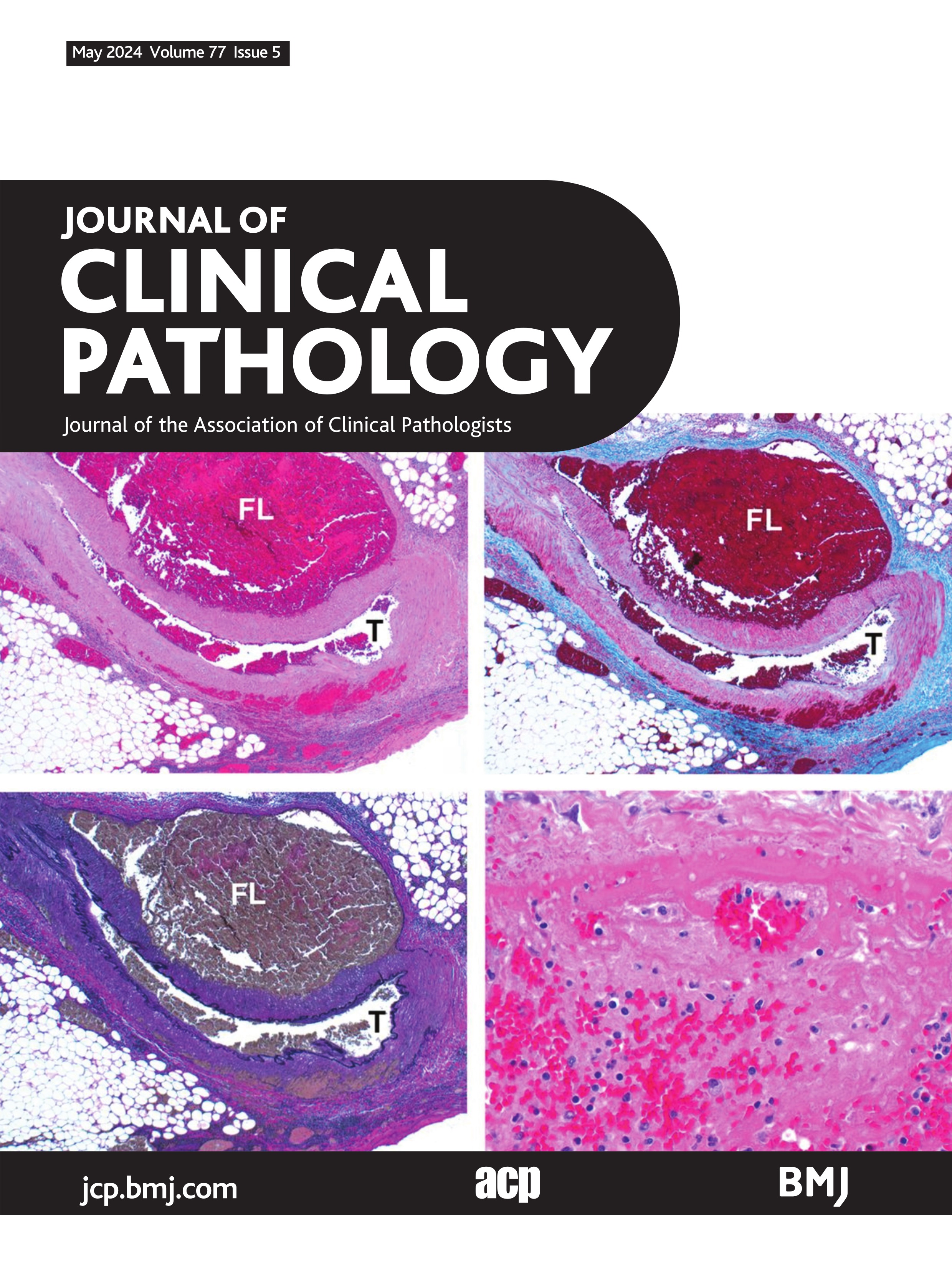 Dematiaceous fungal infections: clinical and pathologic conundrums