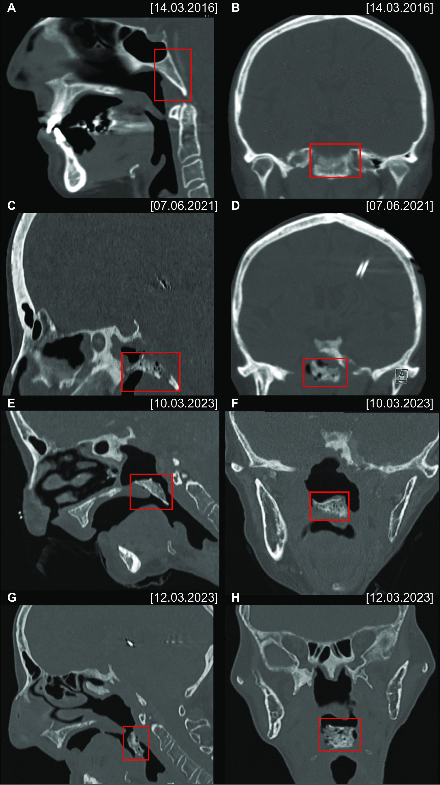 An Unknown Foreign laryngeal Object: an exotic complication of skull base osteoradionecrosis