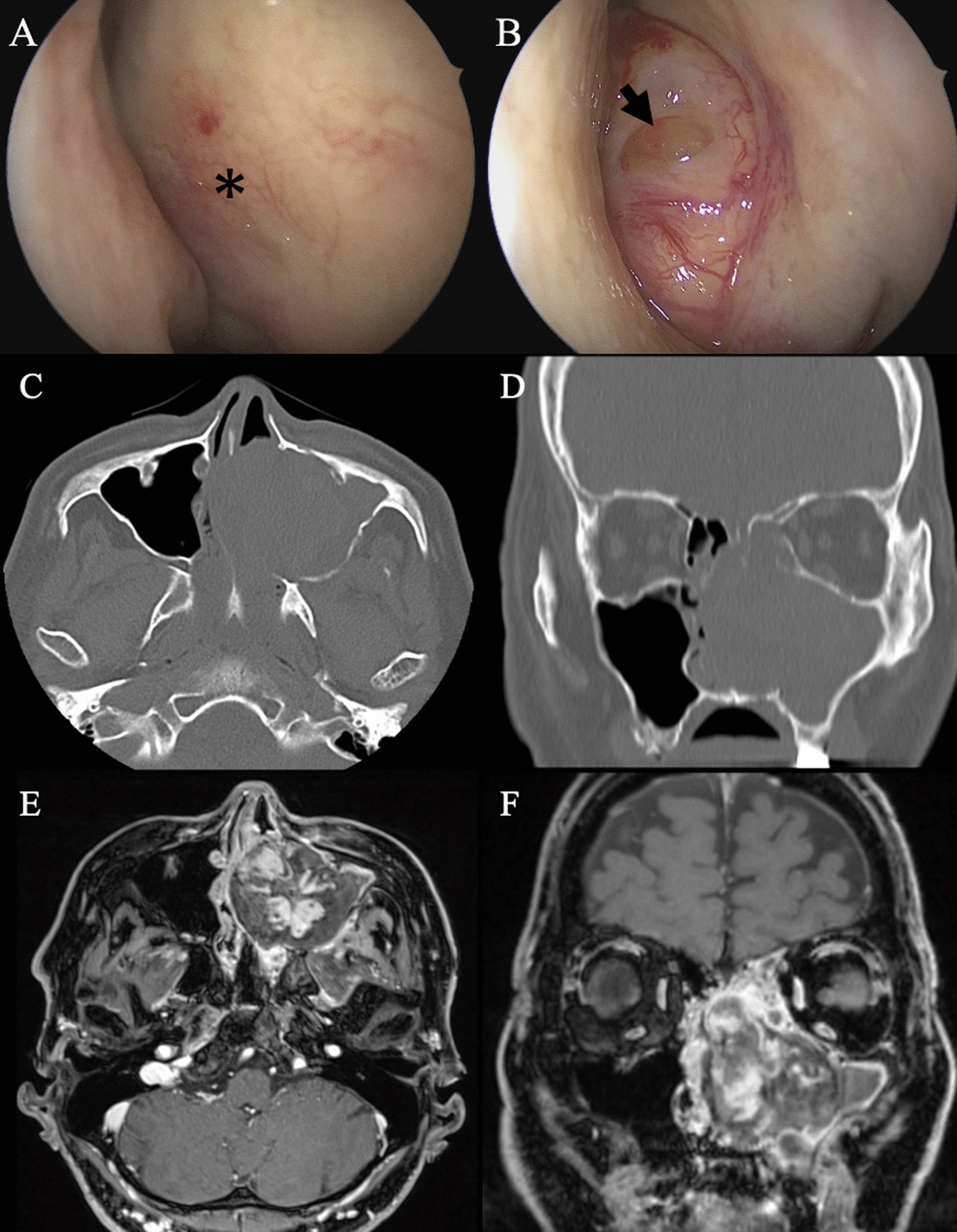 Intravascular papillary endothelial hyperplasia of the maxillary sinus extending into the contralateral nasal cavity