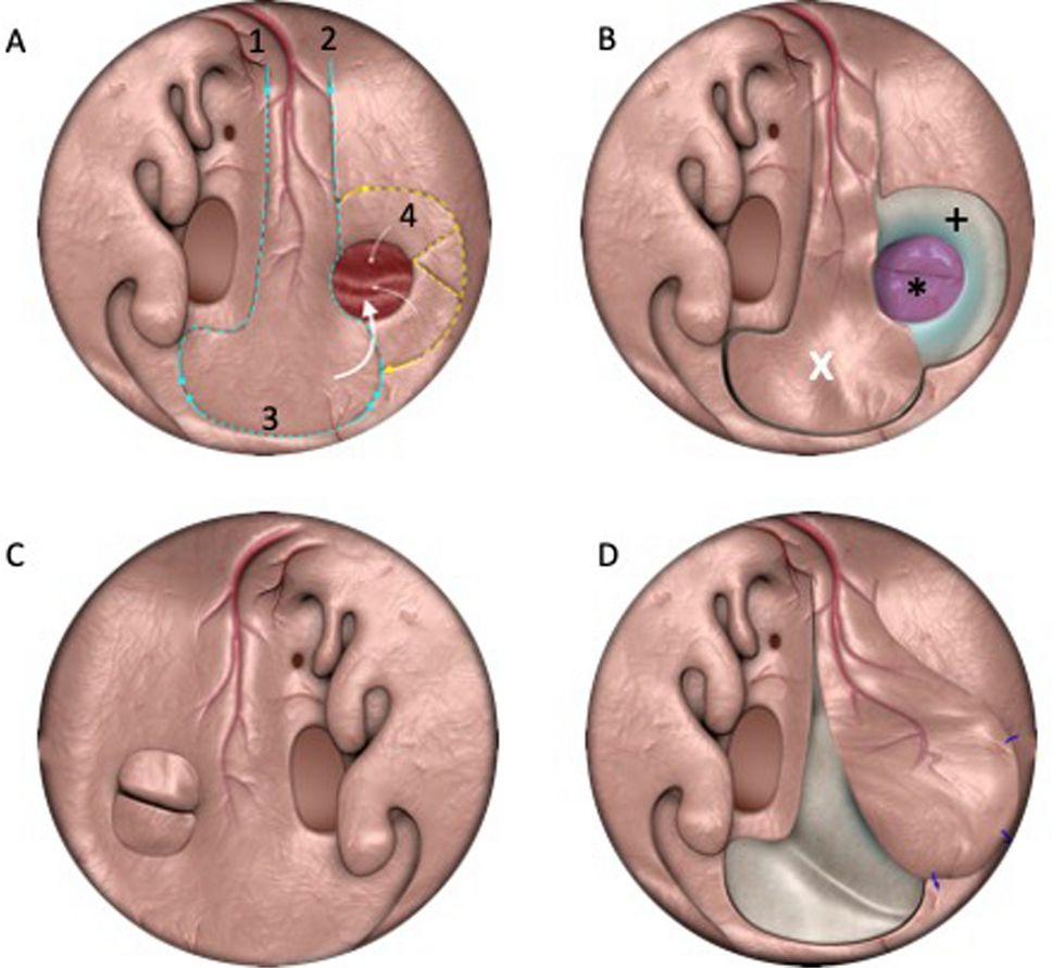 “Boot-on-Donut” procedure for anterior and large septal perforation