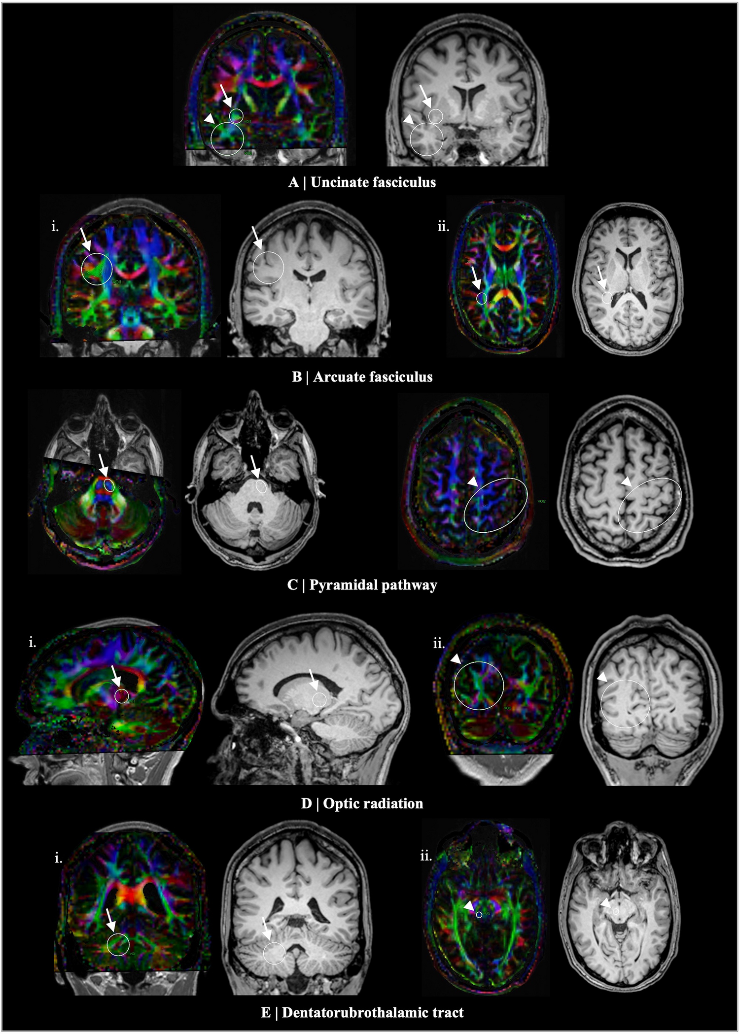 From images to insights: a neuroradiologist’s practical guide on white matter fiber tract anatomy and DTI patterns for pre-surgical planning