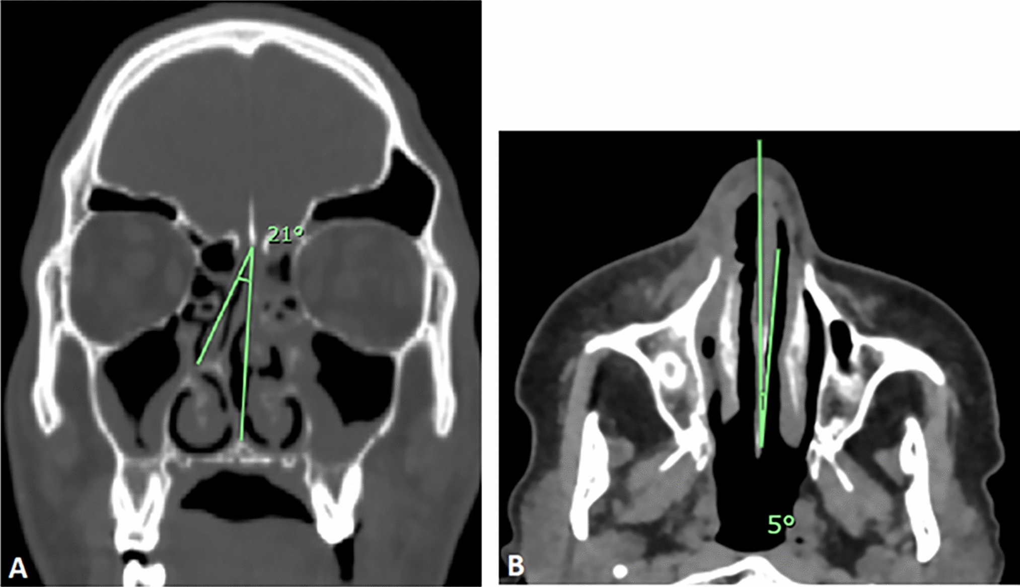 Nasal Septum Deviation in Patients with Acute Invasive Fungal Rhinosinusitis in a Tertiary Care Hospital: A Cross-Sectional Study