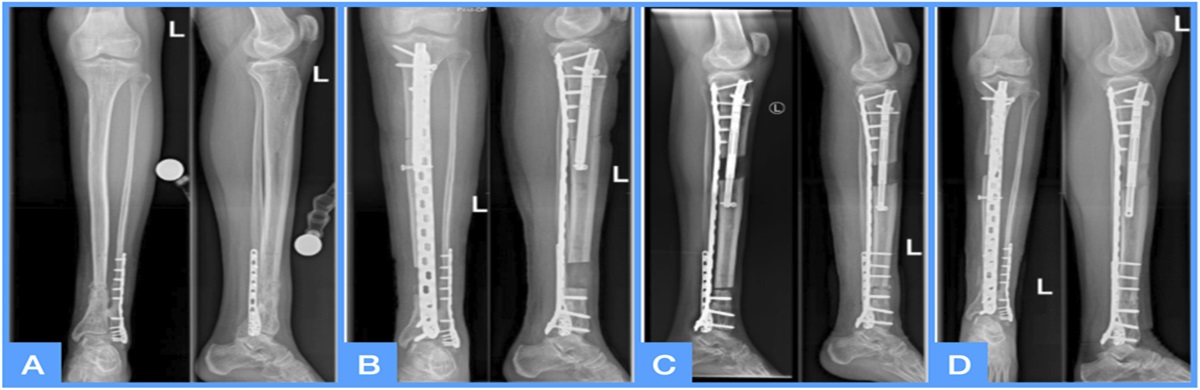 Treatment of Large Femoral and Tibial Bone Defects With Plate-Assisted Bone Segment Transport