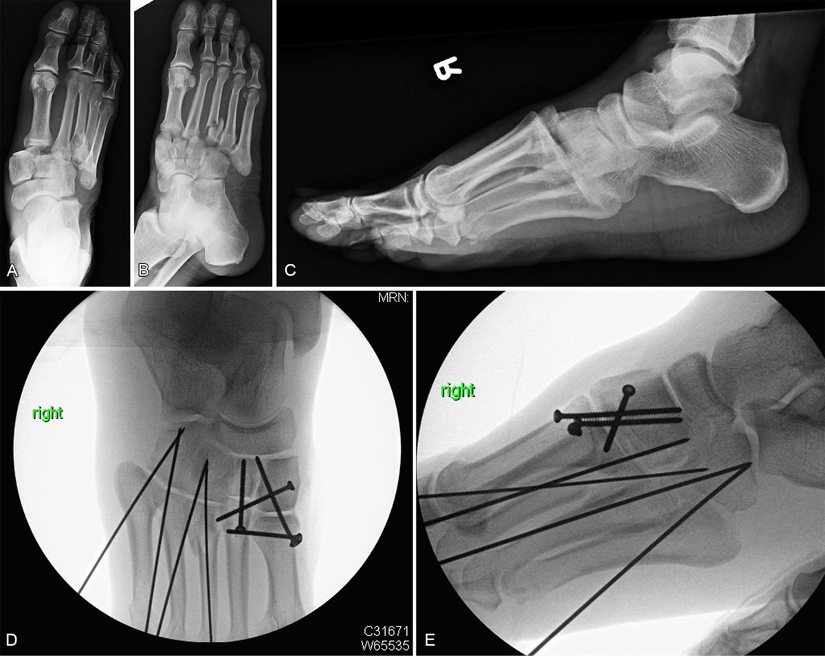 Complications and Outcomes After Fixation of Lisfranc Injuries at an Urban Level 1 Trauma Center