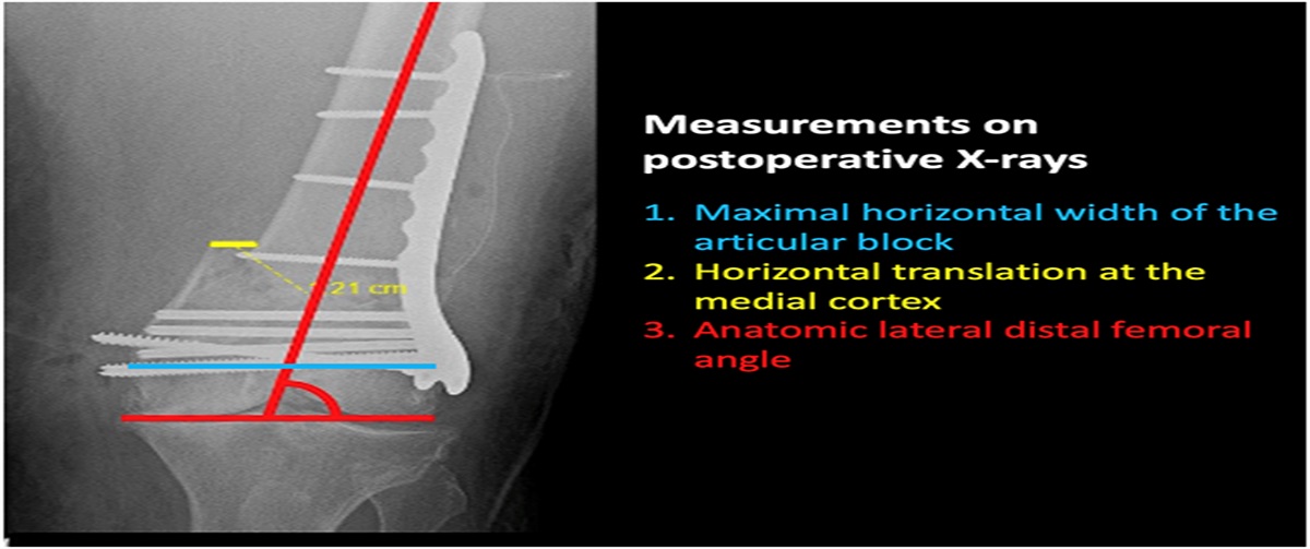 Risk Factors of Failure in 228 Periprosthetic Distal Femur Fractures: A Multicenter Study