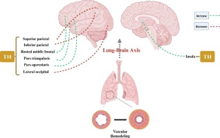 Causal association of depression, anxiety, cognitive performance, the brain cortical structure with pulmonary arterial hypertension: A Mendelian randomization study