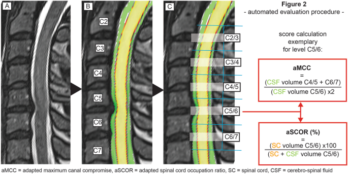 Quantification of cervical spinal stenosis by automated 3D MRI segmentation of spinal cord and cerebrospinal fluid space