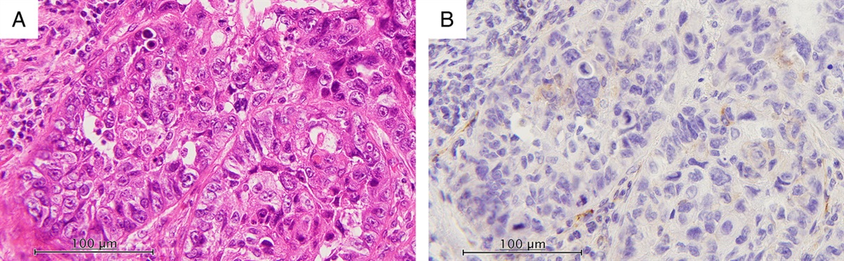 Reply to “Correspondence: SPARC, HEG1, and the Diagnosis of Epithelioid Mesothelioma” by Churg et al