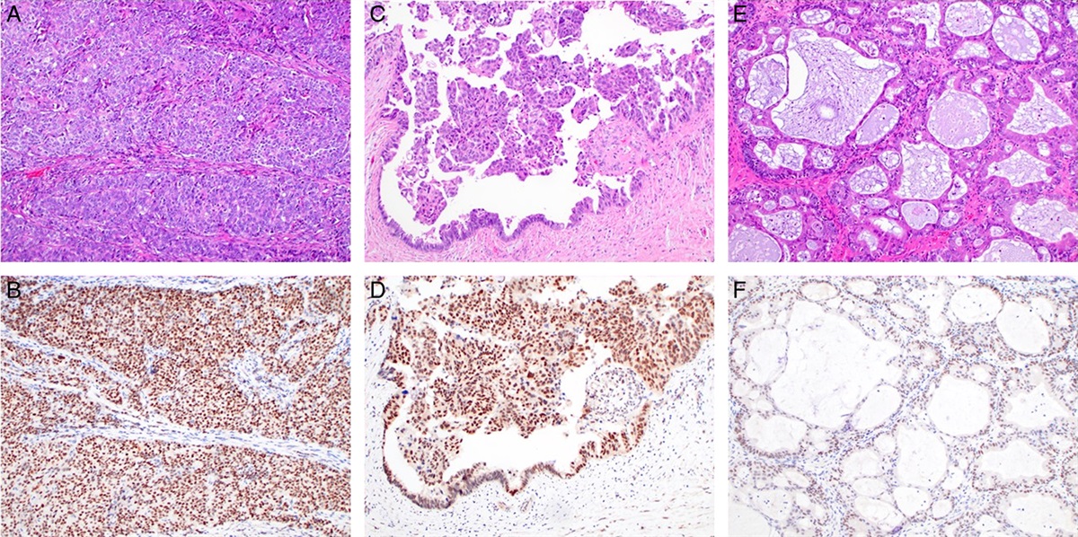 Trichorhinophalangeal Syndrome Type 1 Immunohistochemical Expression in Carcinomas of Gynecologic Origin