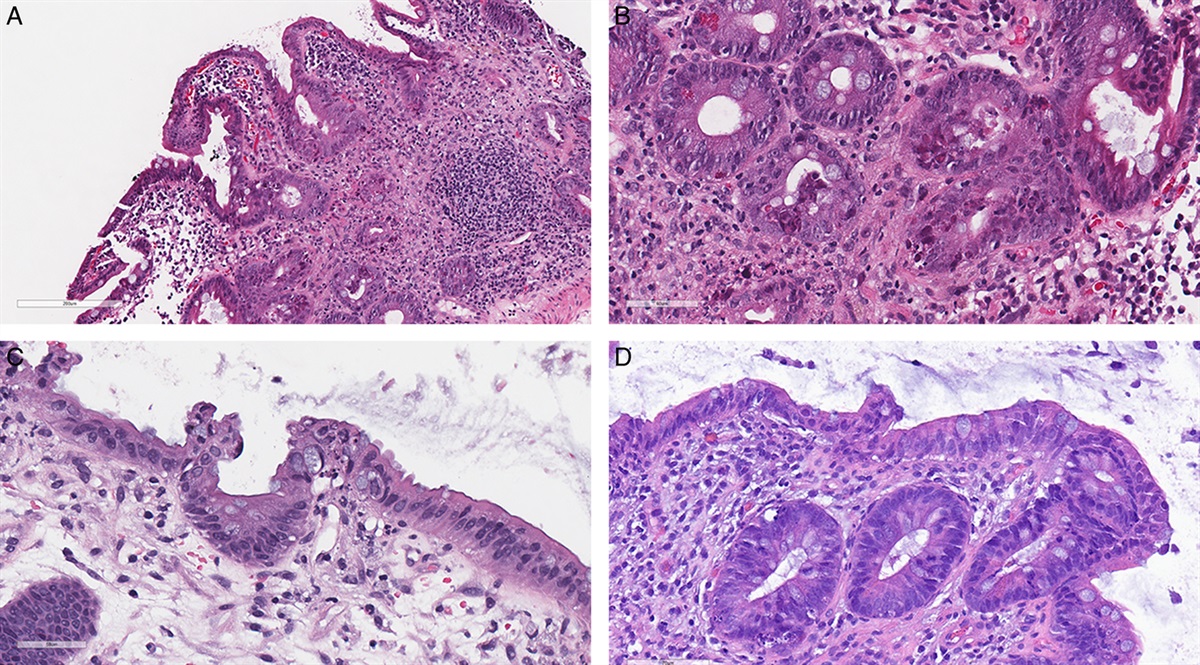 Histologic Manifestations of Gastrointestinal Adenovirus Infection After Stem Cell Transplant