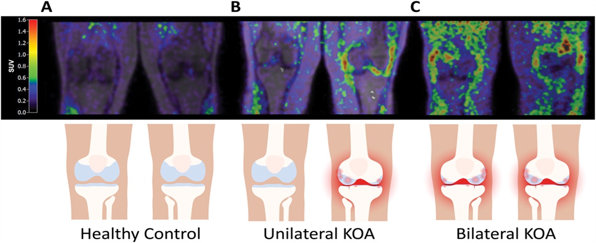[11C]-PBR28 positron emission tomography signal as an imaging marker of joint inflammation in knee osteoarthritis