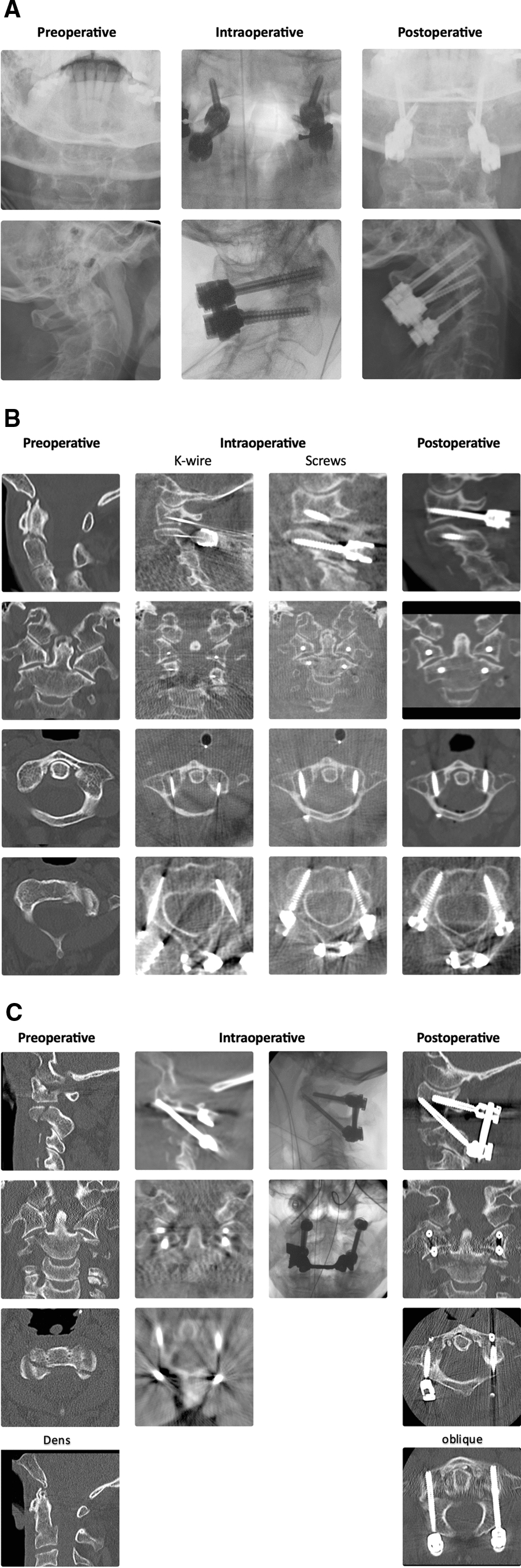 Comparison of iCT-based navigation and fluoroscopic-guidance for atlantoaxial screw placement in 78 patients with traumatic cervical spine injuries
