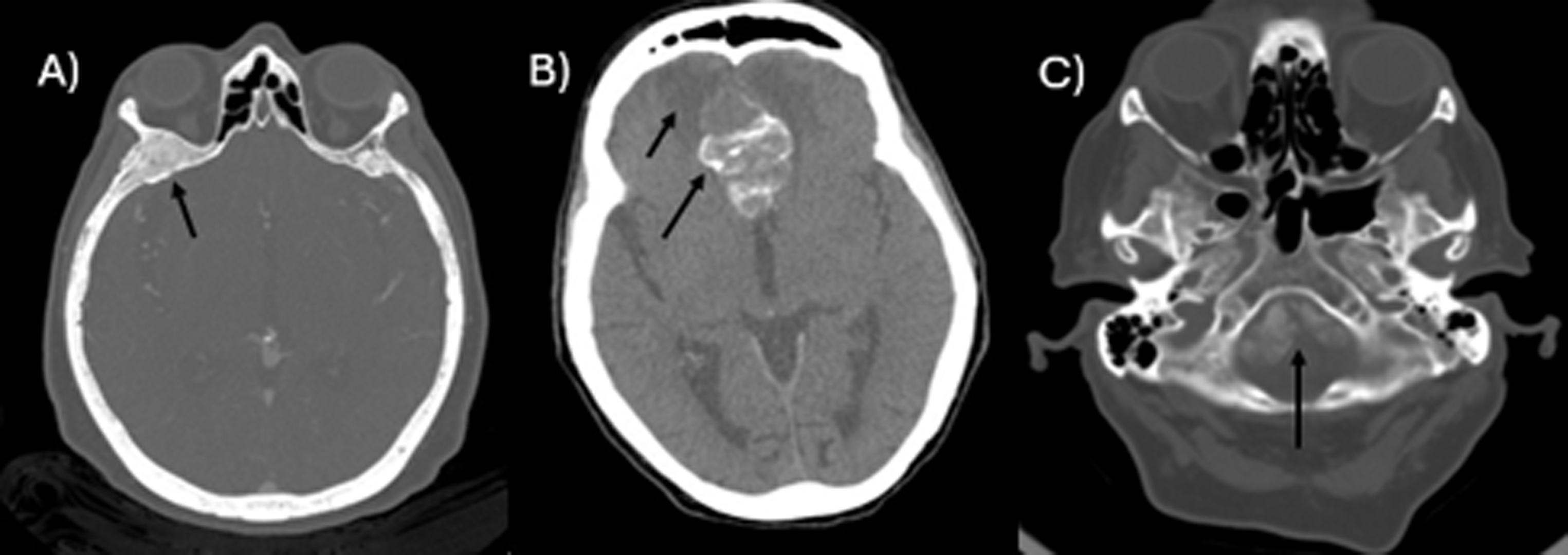 Neuroradiological features of patients with bilateral macronodular adrenocortical disease and meningiomas associated or not with genetic variants of ARMC5– a case series