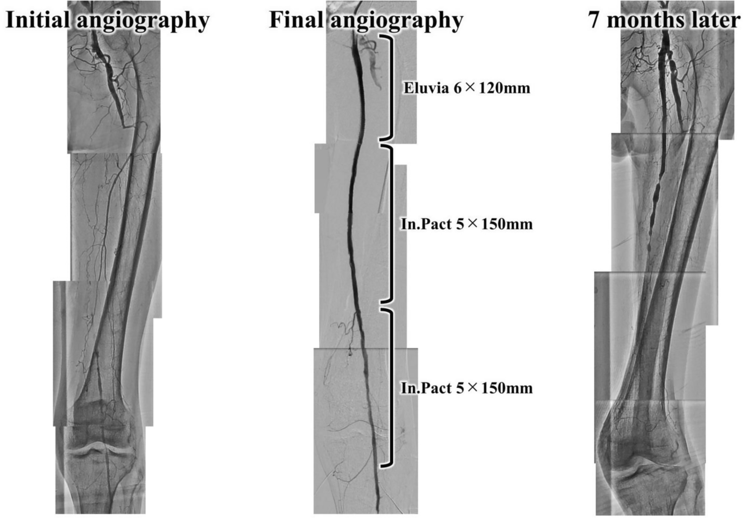 Evaluation of the efficacy of combined device strategies for long femoropopliteal artery disease