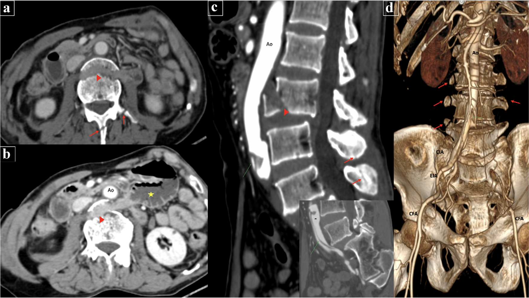 Entrapped bowel within the fractured vertebrae: An extremely rare complication of vertebral fracture