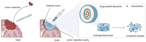 Biodegradable SPI-based hydrogel for controlled release of nanomedicines: A potential approach against brain tumors recurrence
