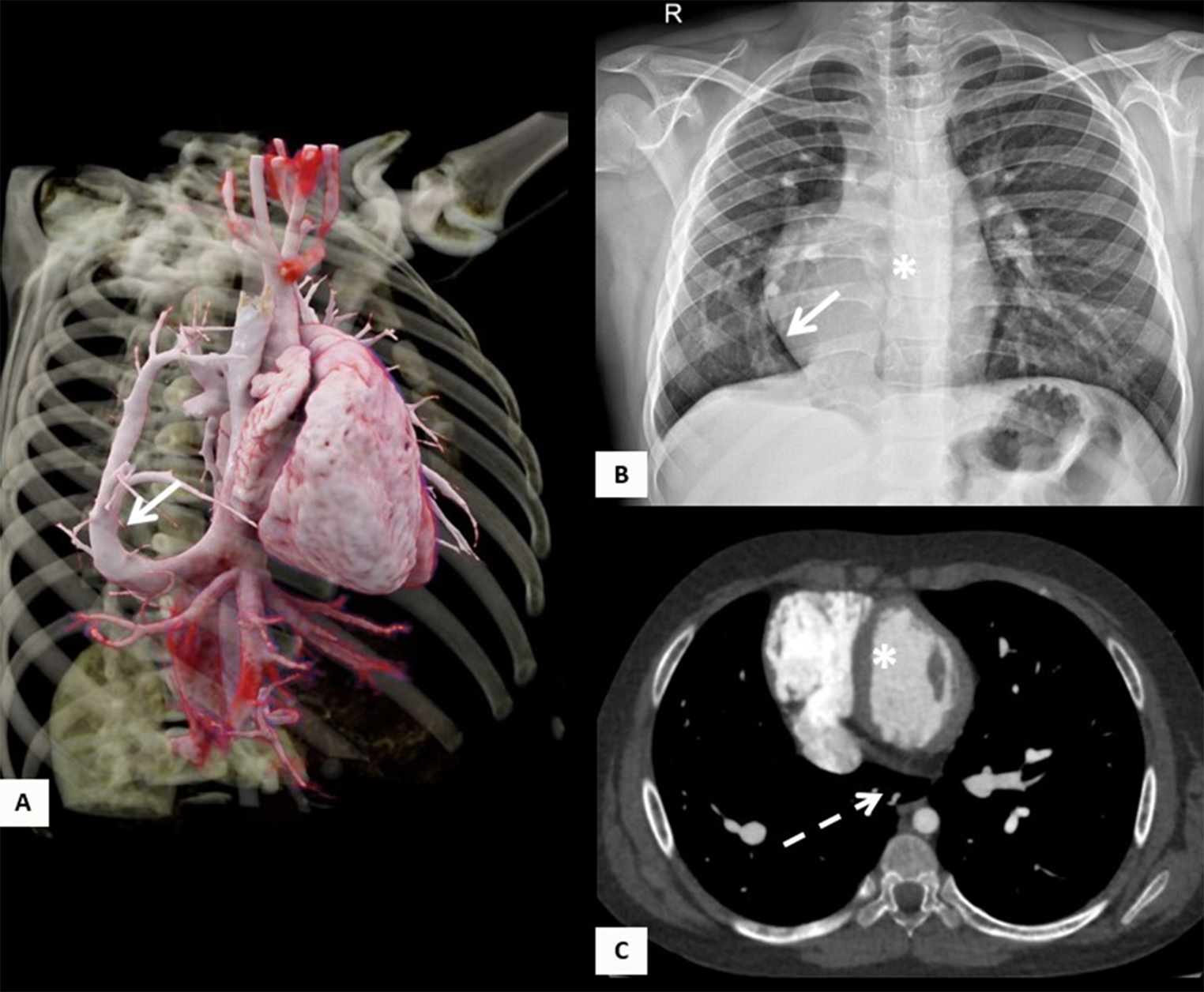 Clinical characteristics, imaging findings, management, and outcomes of patients with scimitar syndrome at a tertiary referral healthcare center in Colombia