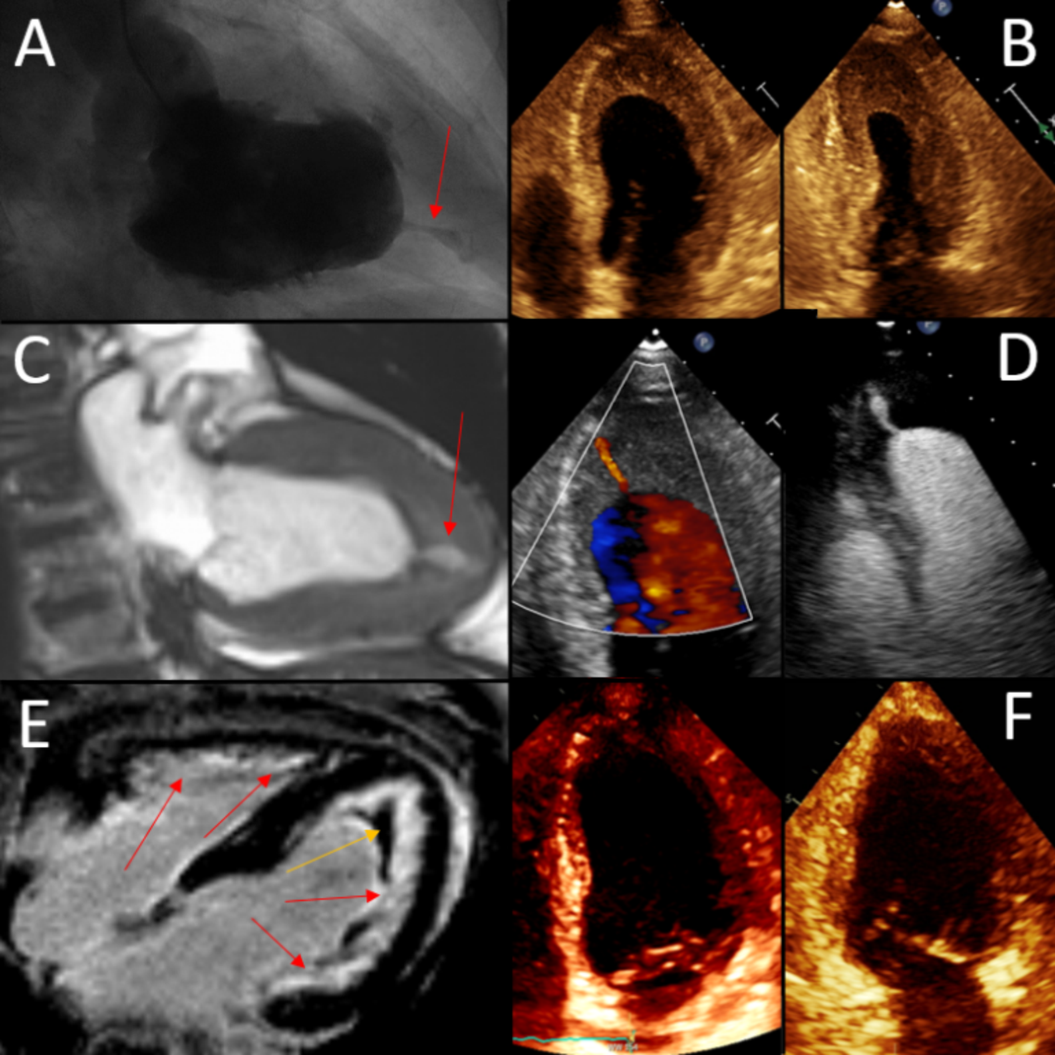 Multimodality imaging of eosinophilic myocarditis (loeffler’s endocarditis) in a patient with idiopathic hypereosinophilic syndrome