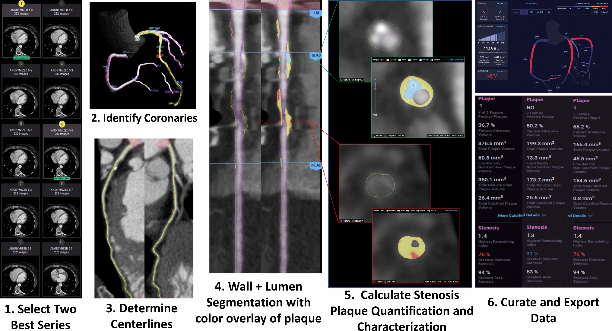 Assessment of atherosclerotic plaque burden: comparison of AI-QCT versus SIS, CAC, visual and CAD-RADS stenosis categories