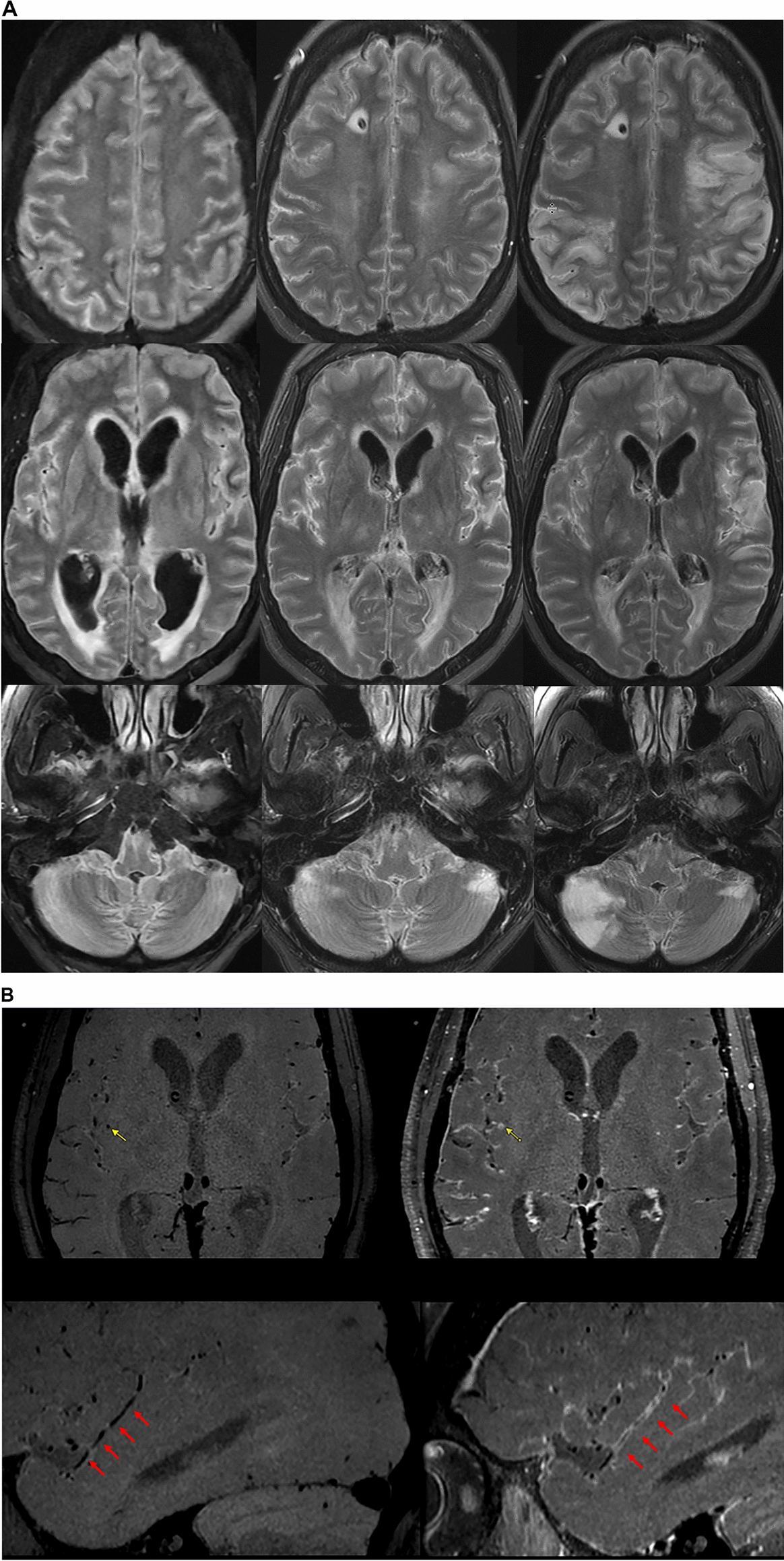 Biphasic Clinical Trajectory in Pneumococcal Meningitis from Cerebral Infarcts