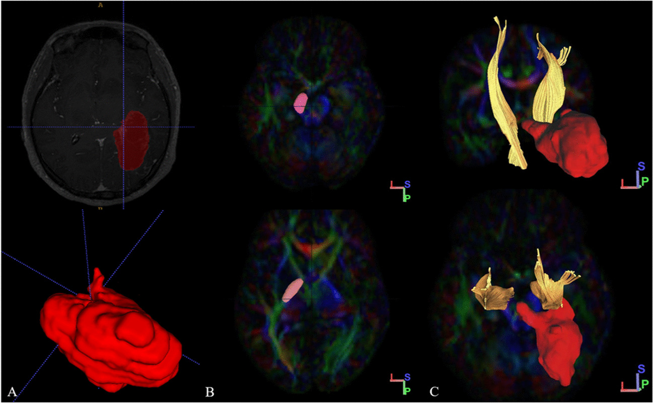 A comparative study of diffusion kurtosis imaging and diffusion tensor imaging in detecting corticospinal tract impairment in diffuse glioma patients