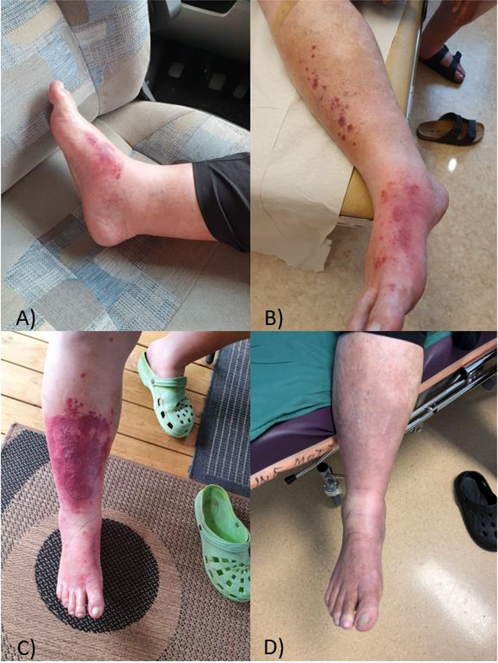 Chromobacterium sp. septicemia in Sweden. A clinical case report