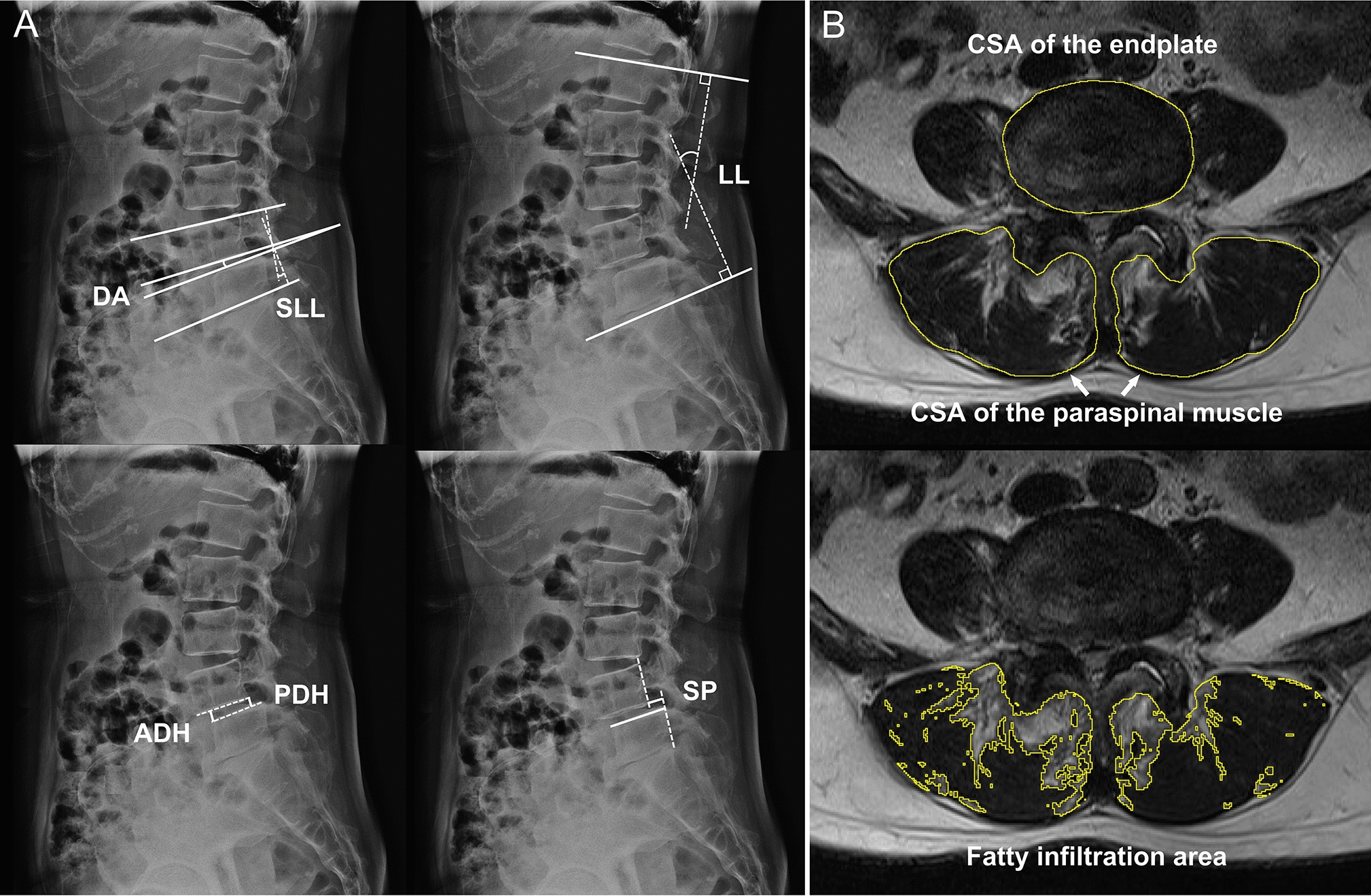 Radiographic and surgery-related predictive factors for increased segmental lumbar lordosis following lumbar fusion surgery in patients with degenerative lumbar spondylolisthesis