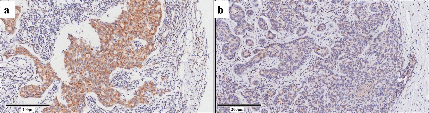 SLC35A2 expression is associated with HER2 expression in breast cancer