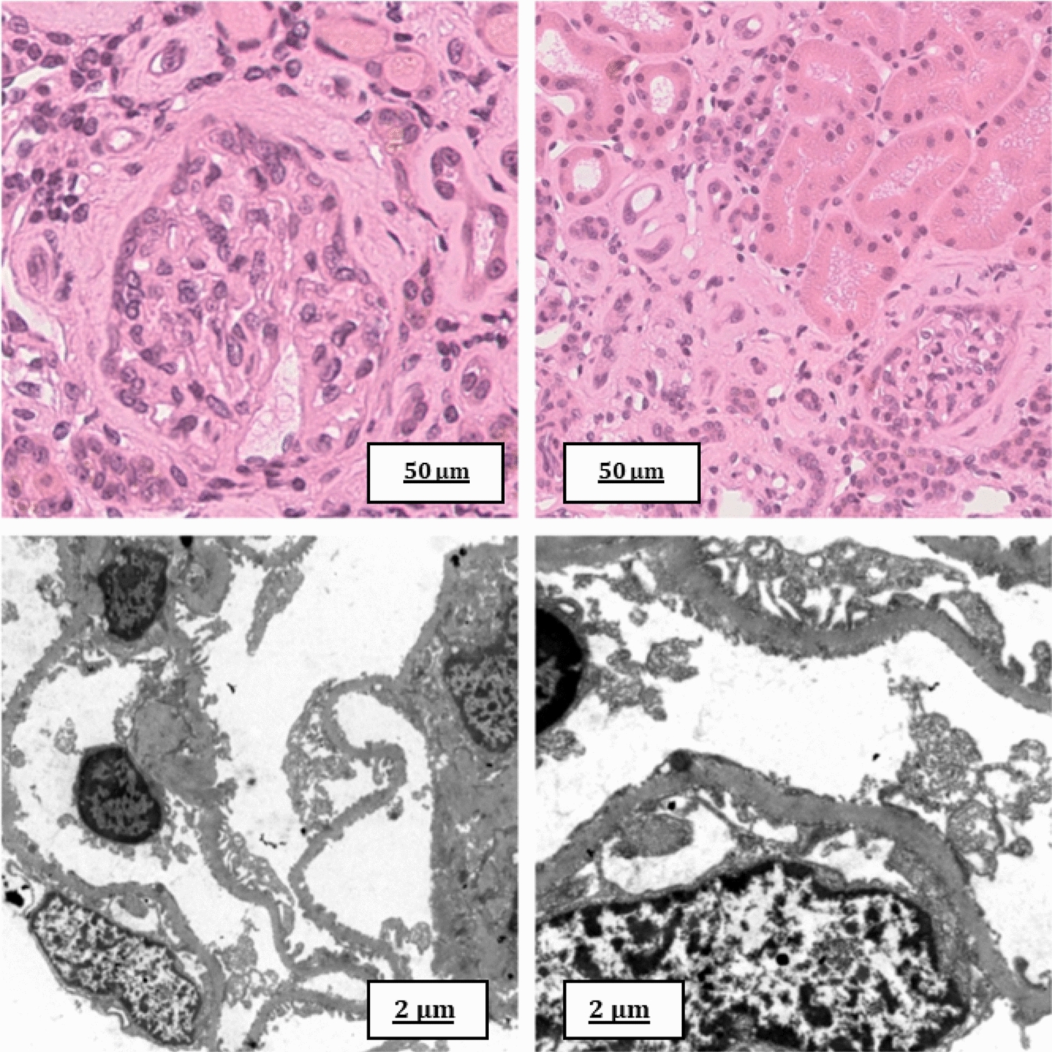 Kidney disease in acute intermittent porphyria: histological features and therapeutic perspectives