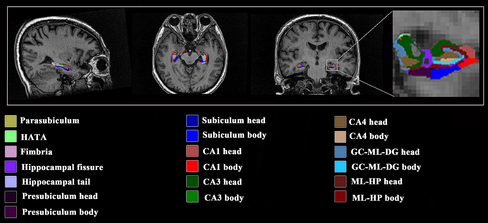 Selective vulnerability of hippocampal sub-regions in patients with subcortical vascular mild cognitive impairment