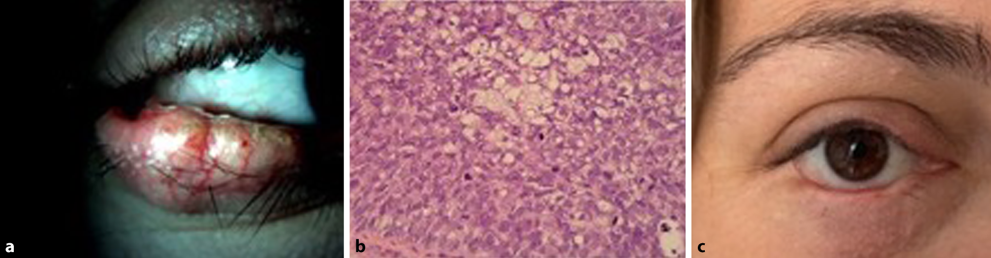 Masqueraded sebaceous gland carcinoma of the lower eyelid in a young pregnant patient