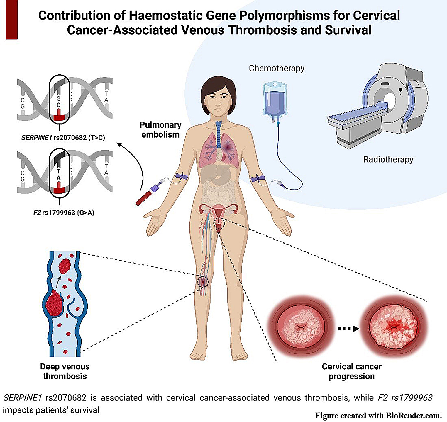 Haemostatic gene variations in cervical cancer-associated venous thrombosis: considerations for clinical strategies