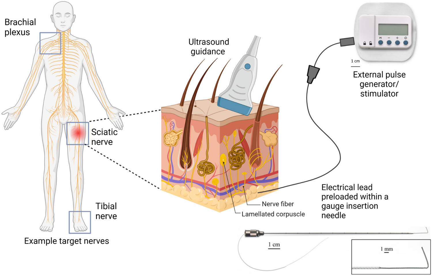 Peripheral Nerve Stimulation in Postoperative Analgesia: A Narrative Review