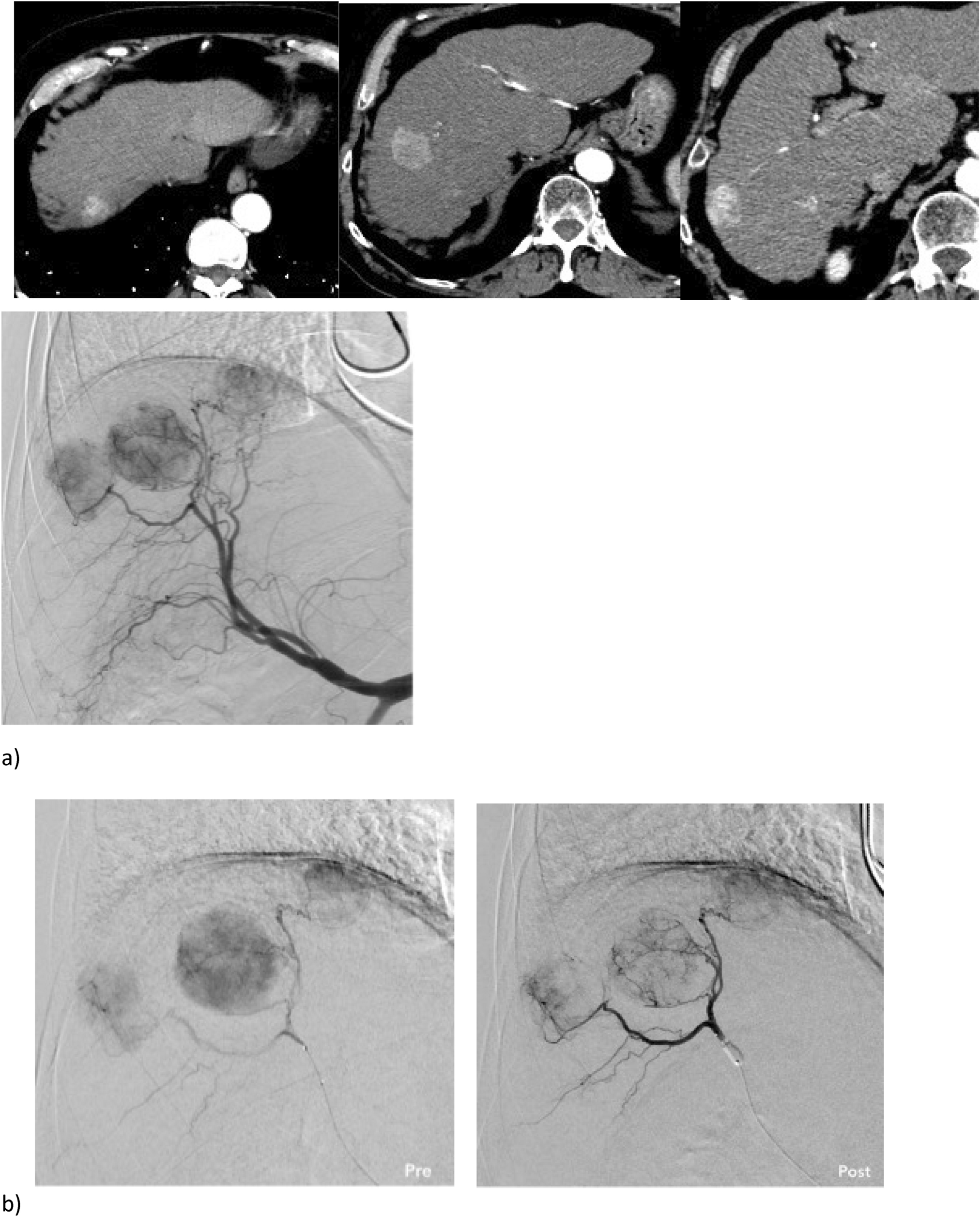 Two-dimensional perfusion angiography permits direct visualization of redistribution of flow in hepatocellular carcinoma during b-TACE