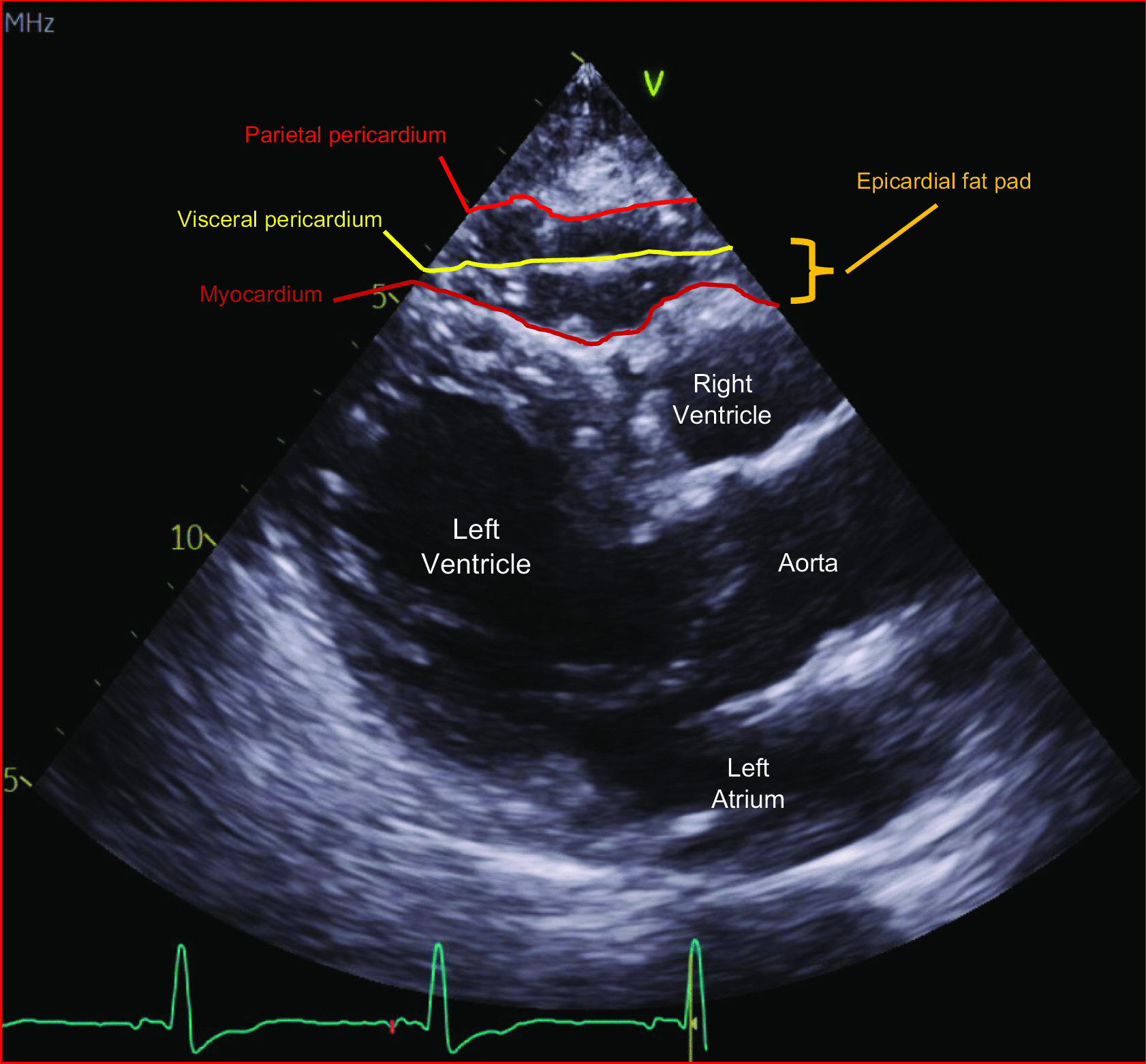 Epicardial Adipose Tissue Thickness and Preserved Ejection Fraction Heart Failure