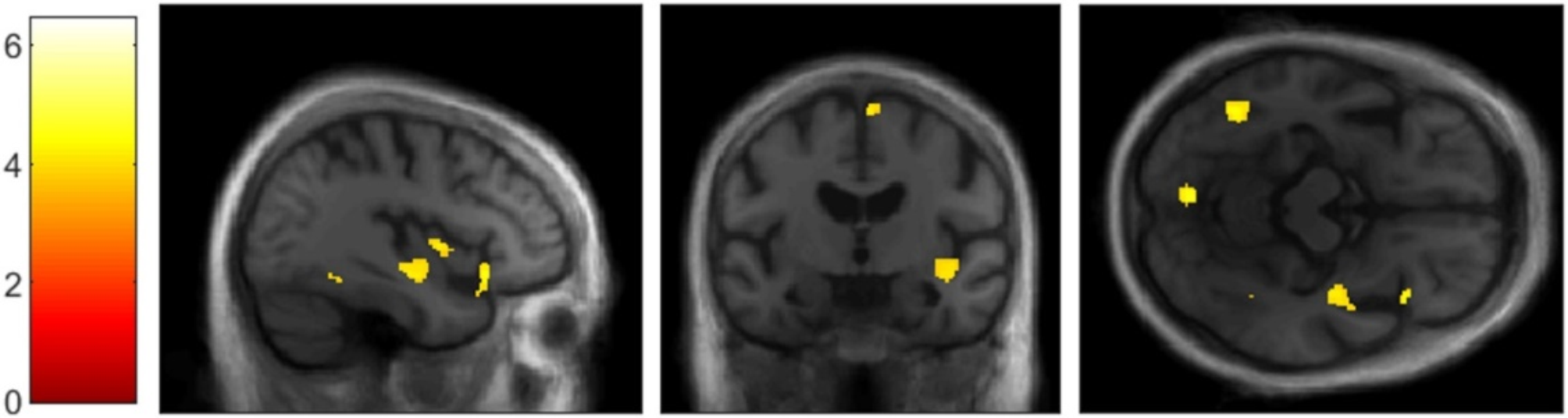 Who am I with my Lewy bodies? The insula as a core region of the self-concept networks