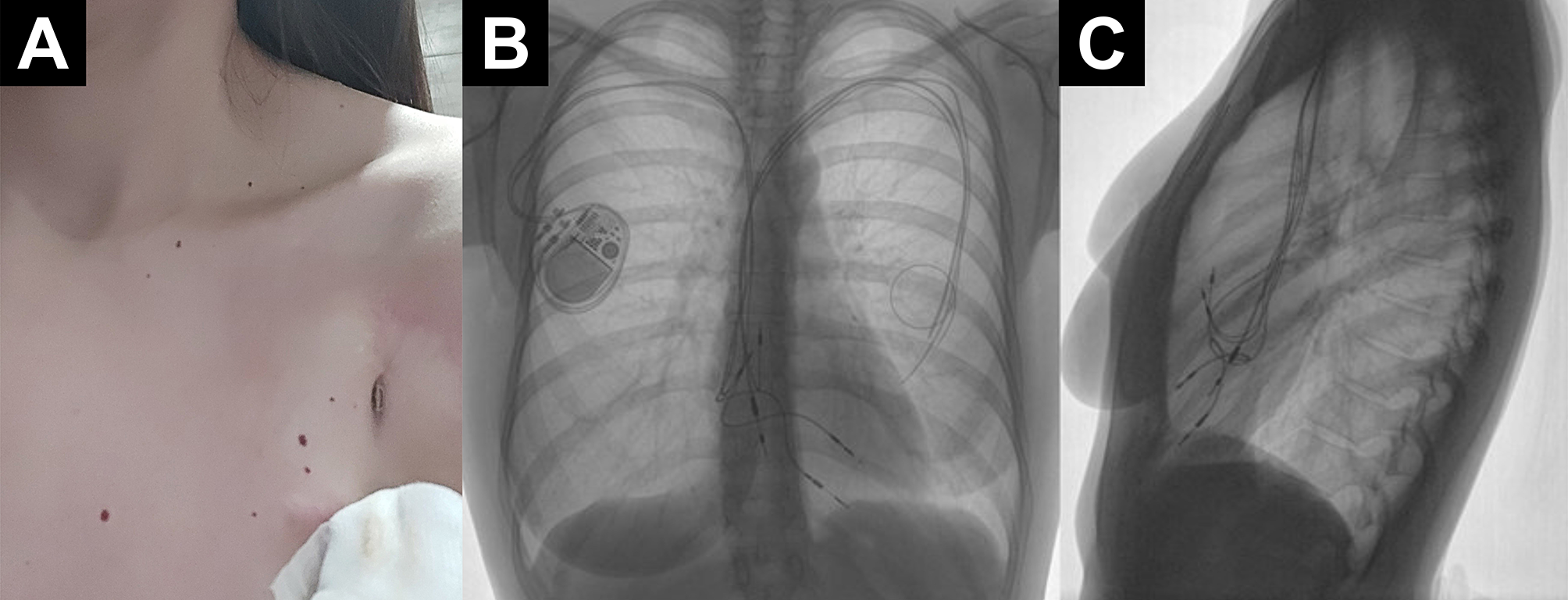 Stepwise transvenous lead extraction due to pacemaker pocket infection following lactational mastitis complicated with breast abscess