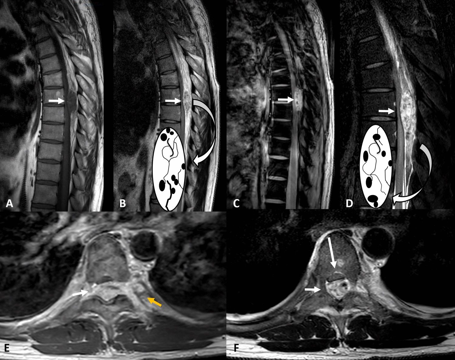 Epidural angioleiomyoma: an extraordinary cause of compressive myelopathy—MRI findings with histopathological correlation