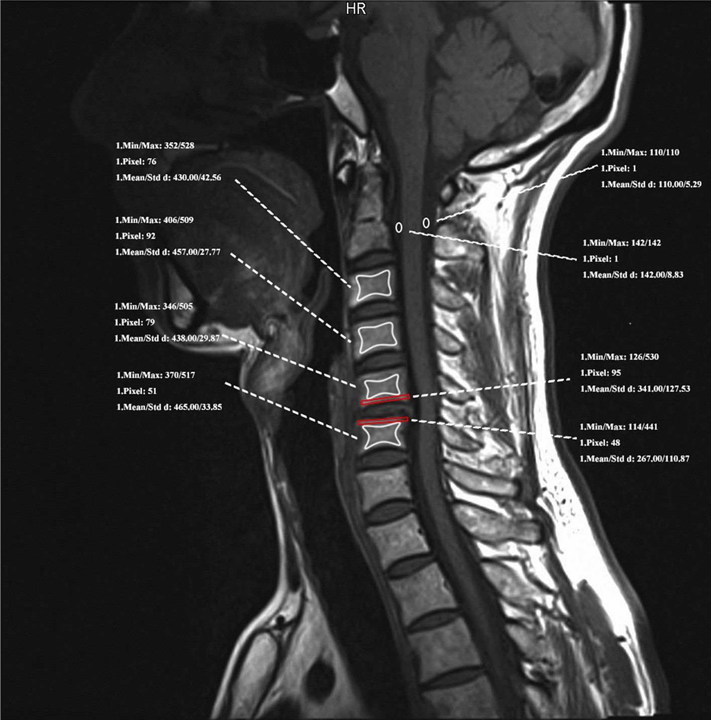 A novel MRI-based Cervical-Endplate Bone Quality score independently predicts cage subsidence after Anterior Cervical Discectomy and Fusion