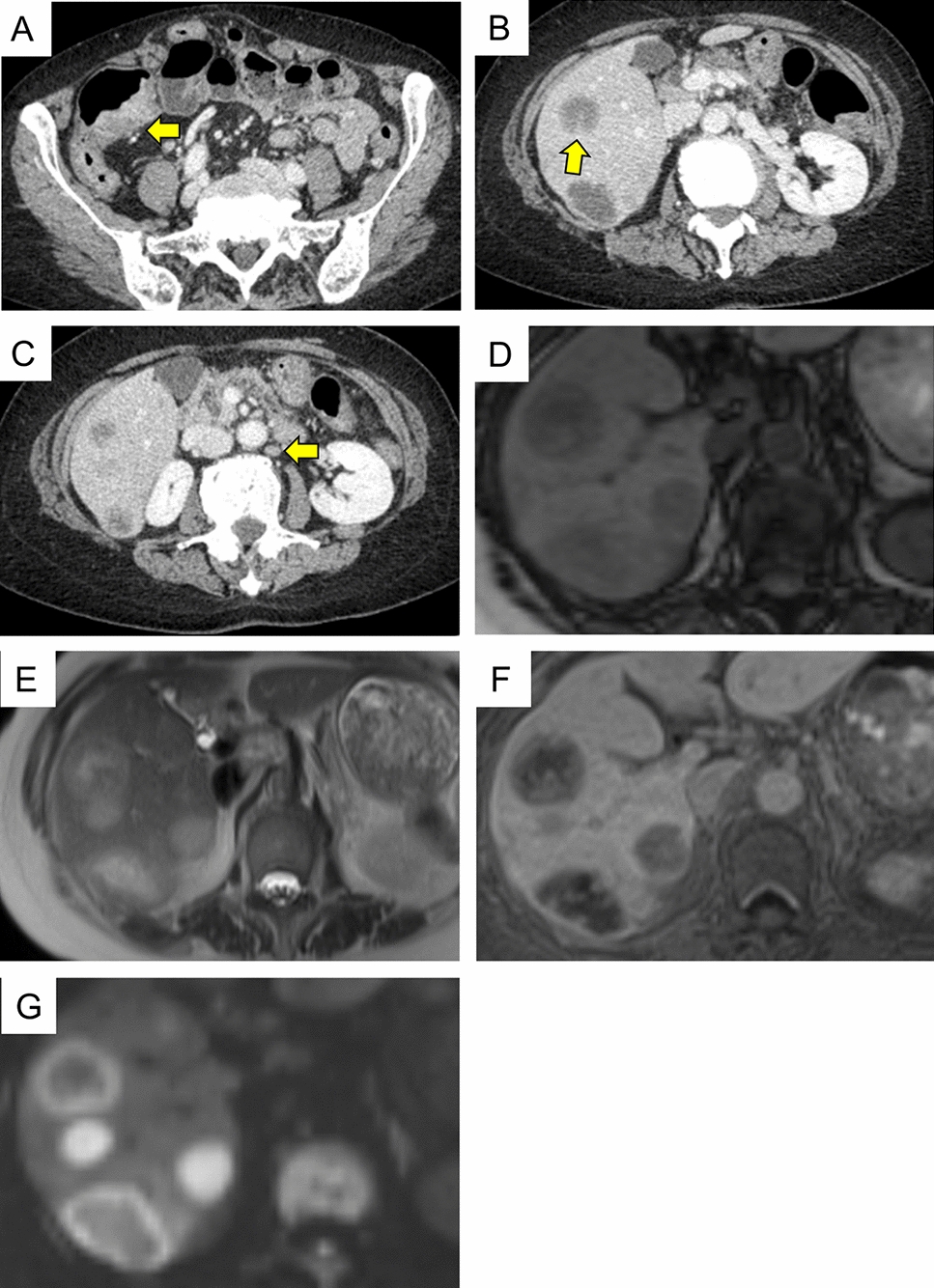 A case of methotrexate-related lymphoproliferative disease showing multiple liver lesions in a patient with rheumatoid arthritis