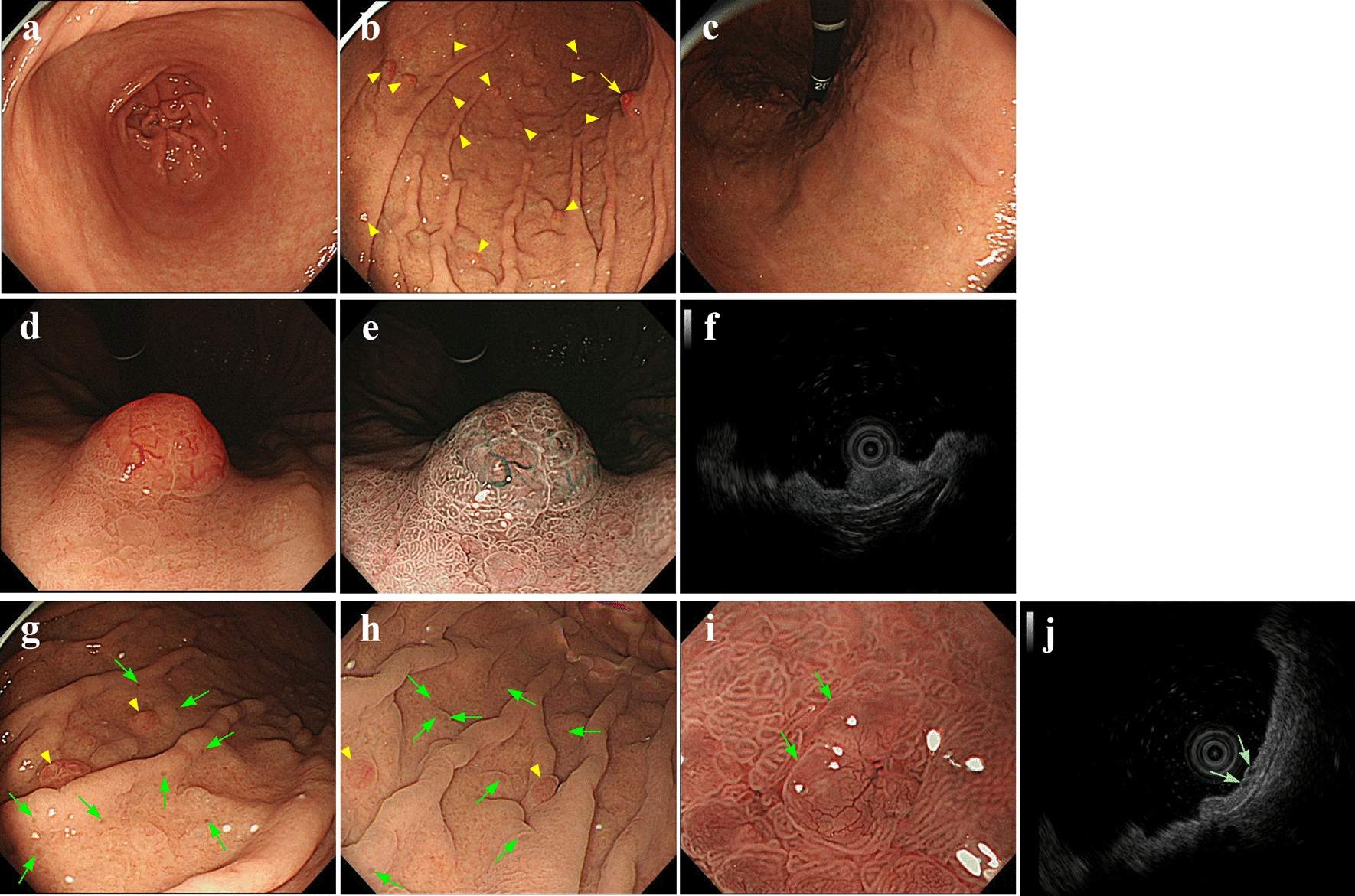 Multiple gastric neuroendocrine tumors in a patient with parietal cell dysfunction and adenosine triphosphatase H+/K+ transporting subunit alpha gene variant
