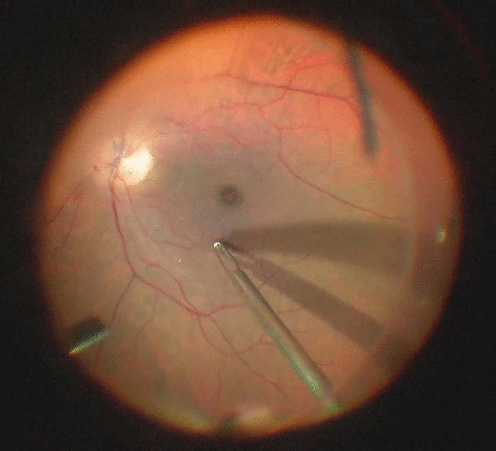 Short-term results of surgical treatment in large idiopathic macular hole cases