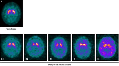 Practical use of DAT SPECT imaging in diagnosing dementia with Lewy bodies: a US perspective of current guidelines and future directions