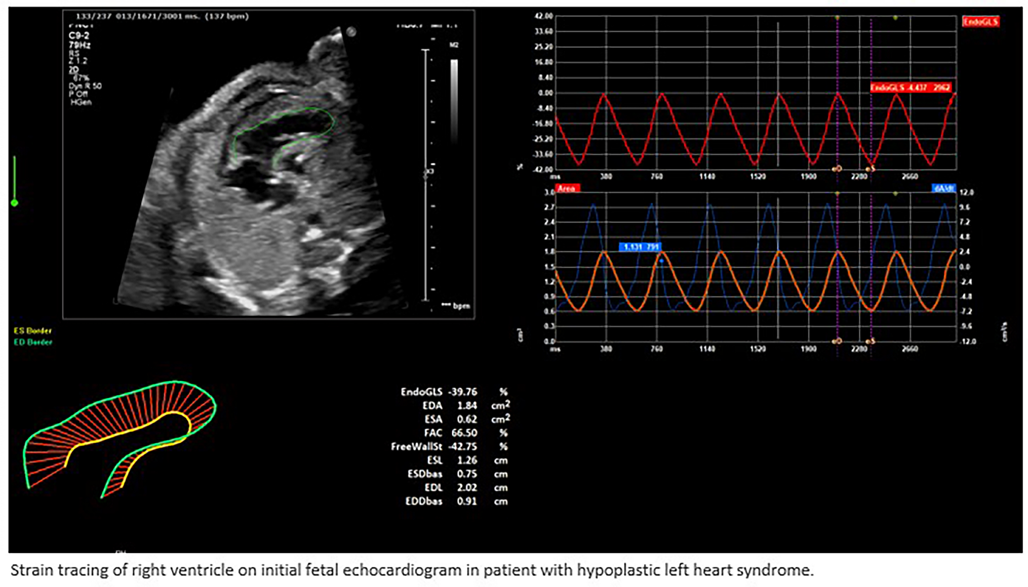 Fetal Echocardiographic Evaluation of Tricuspid Valve and Right Ventricular Function Including Global Longitudinal Strain in Hypoplastic Left Heart Syndrome and Association with Postnatal Outcomes