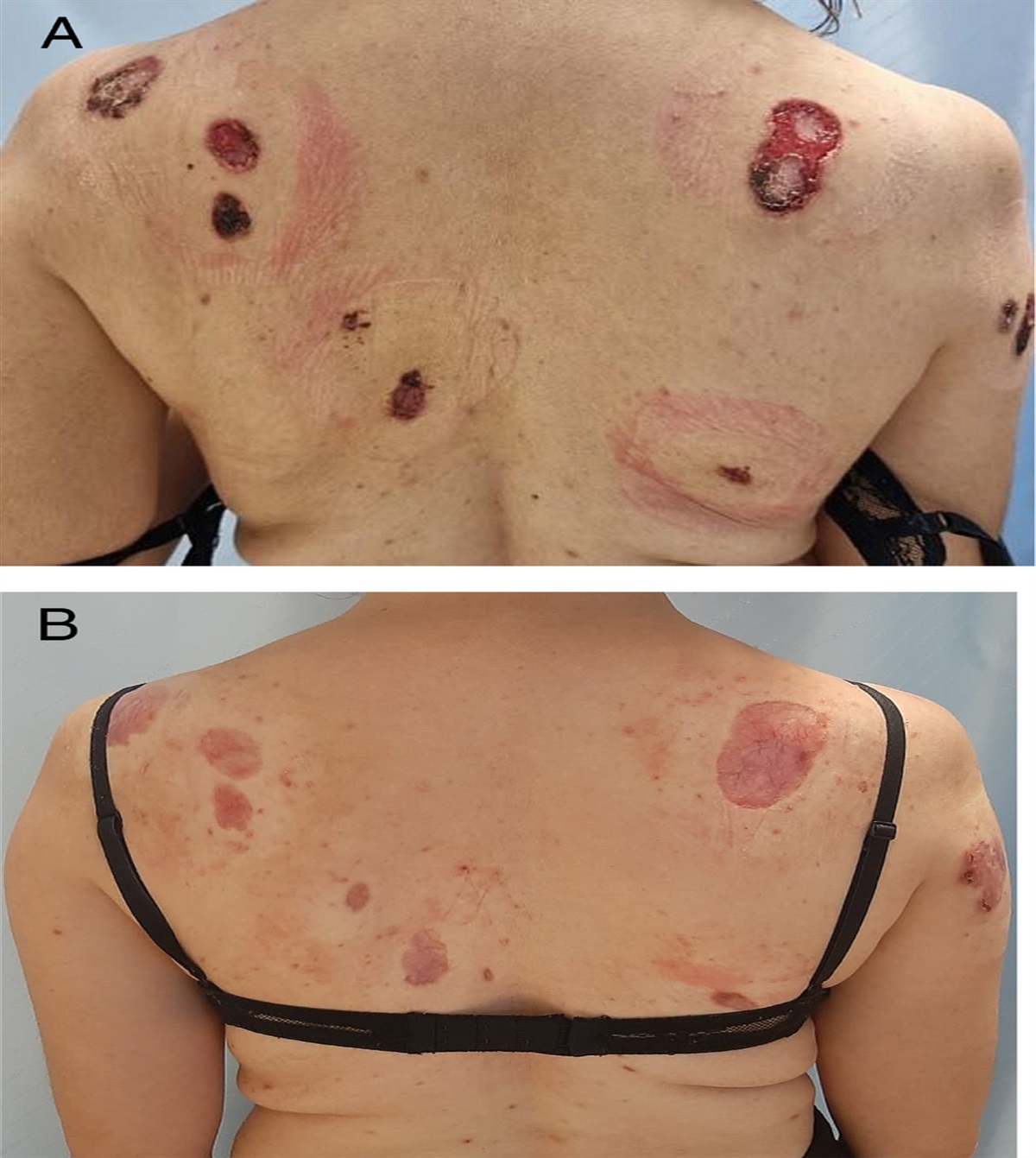 Risankizumab as a Therapeutic Approach for Recalcitrant Pyoderma Gangrenosum
