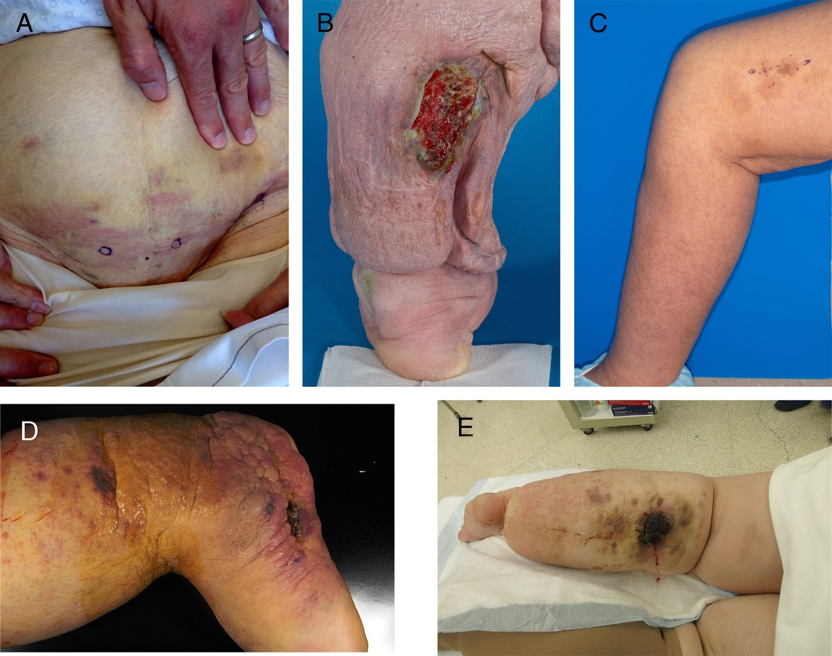 Lower Extremity Angiosarcoma: A Life-Threatening Complication of Lymphedema