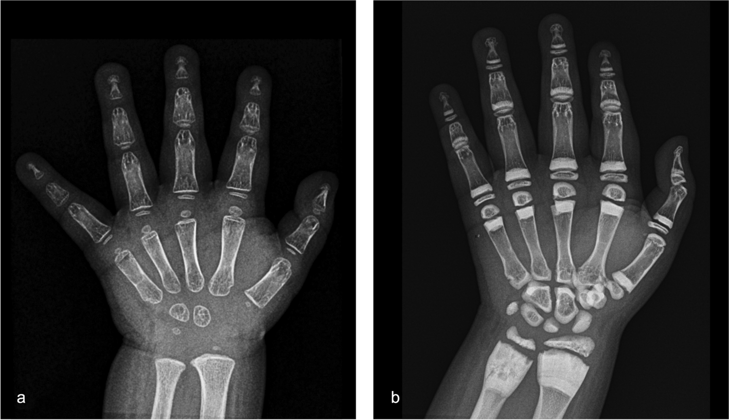 Denosumab-induced bone changes in a child: a case report