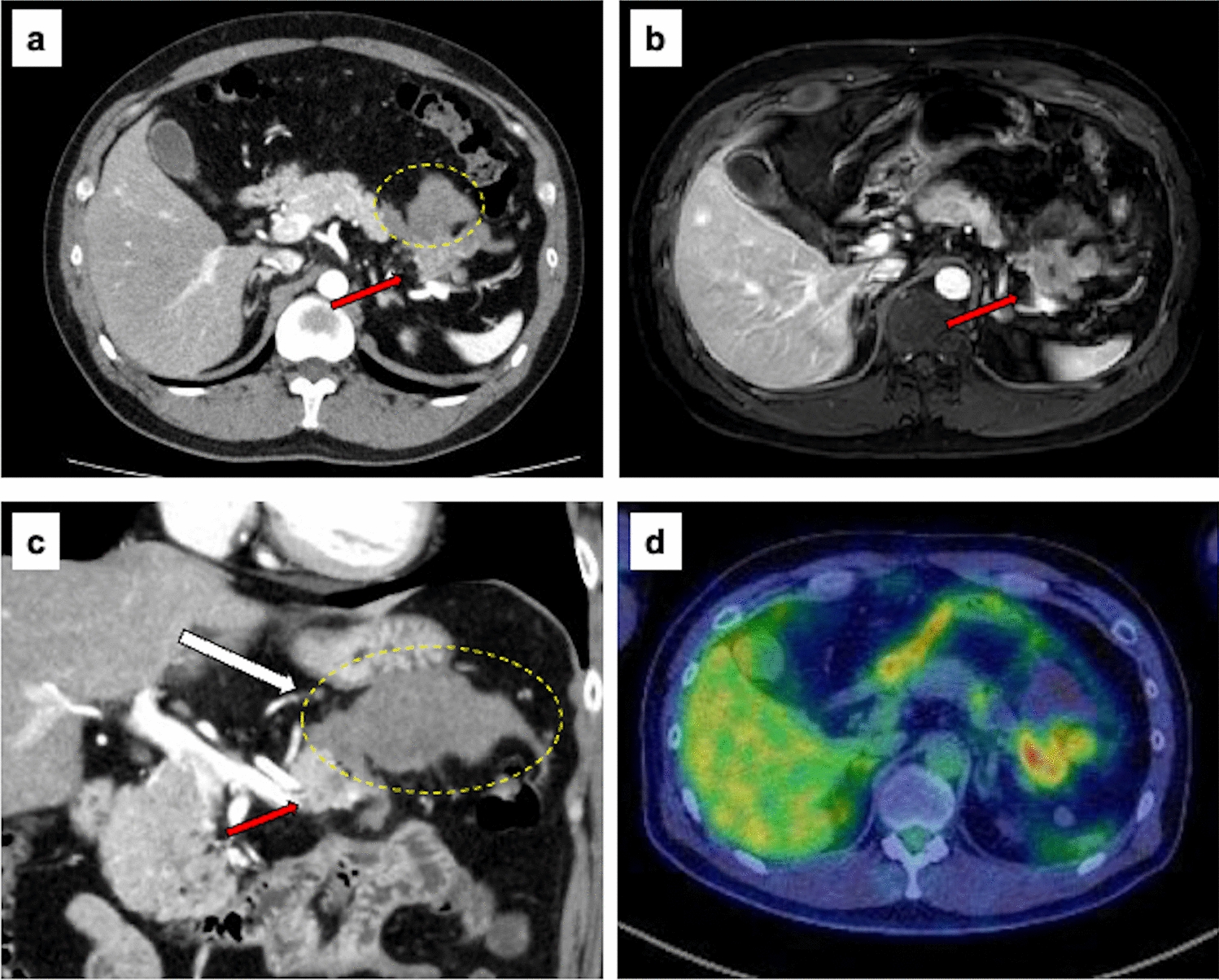 Successful curative treatment for a ruptured pancreatic acinar cell carcinoma by radical resection following modified FOLFIRINOX: a case report and literature review